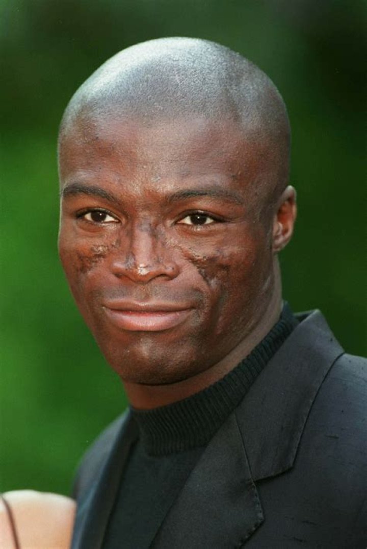 What Happened To Seal That Caused The Extensive Scarring On His Face?