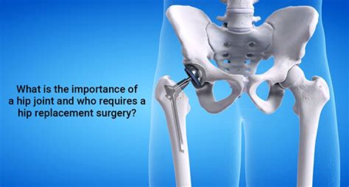 
Why is Alec Baldwin using a crutch? Hip replacement surgery explored 