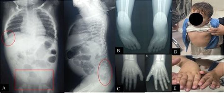 Zion Clark Talks Anatomy and Walking With His Hands, This Is How Caudal Regression Syndrome Works